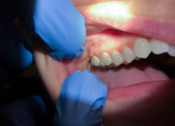 Best Emergency Dental Care for Abscessed Tooth in Glenarden, MD